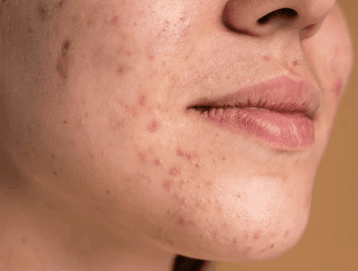 Dermatologic Surgery