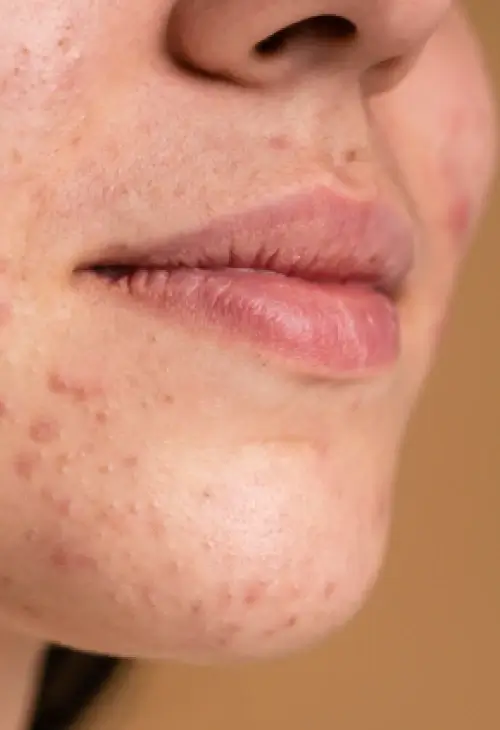 Laser Resurfacing